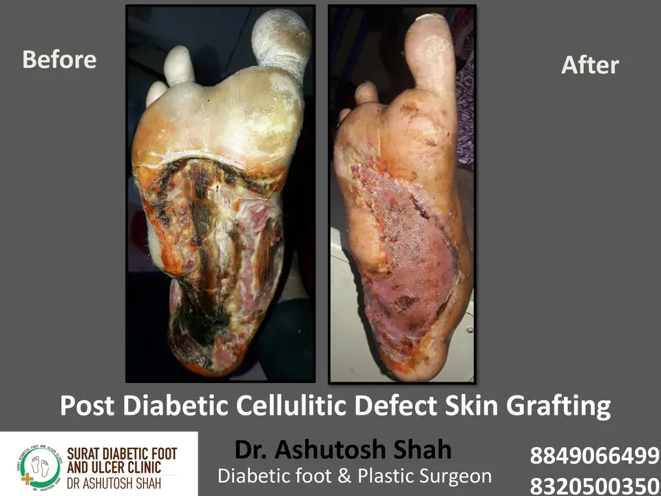 Diabetic Cellulitis and Coverage.pptx-15.webp